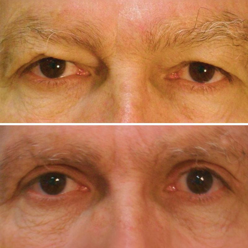 Comparativo antes e depois de blefaroplastia funcional